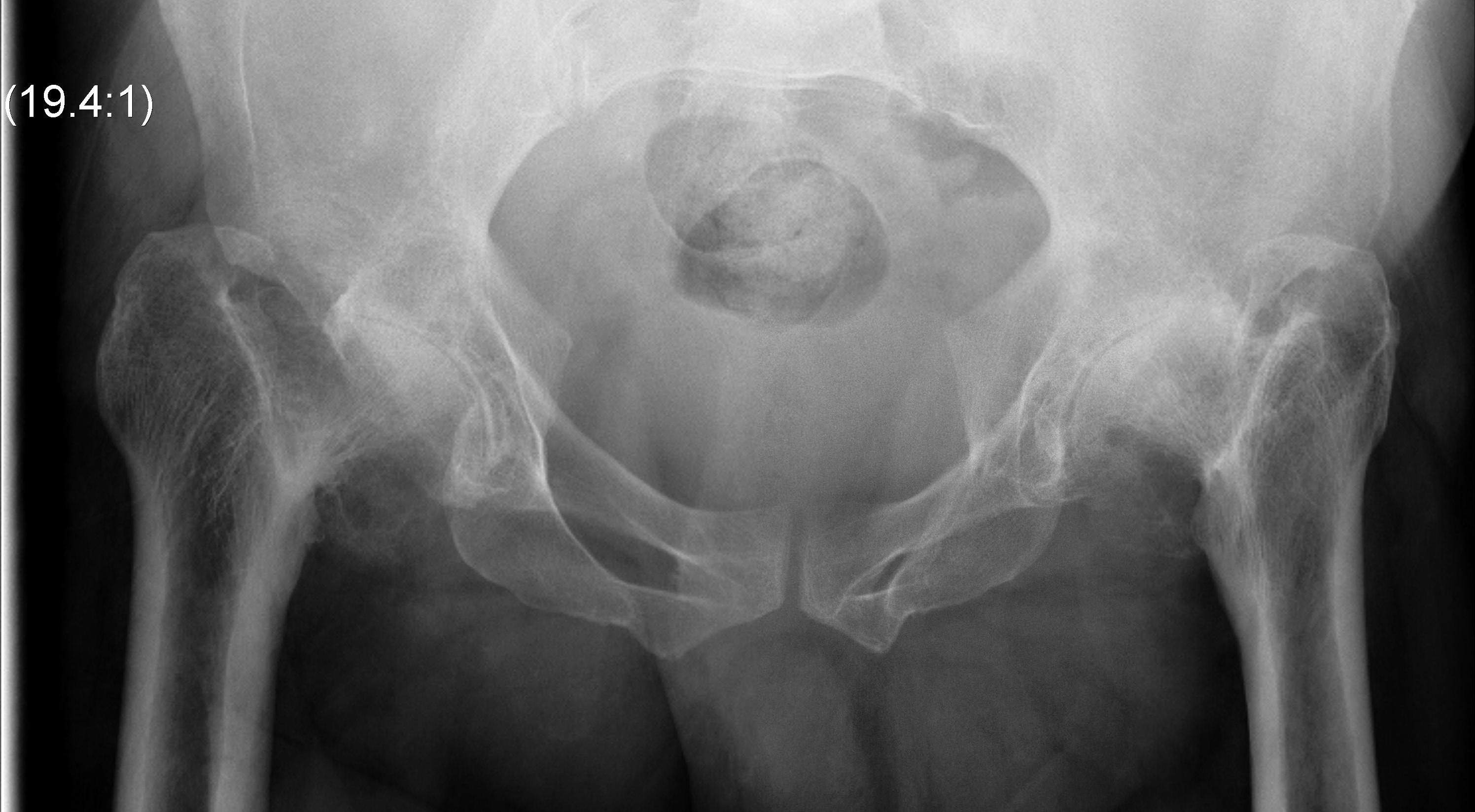 Bilateral Severe Perthes Hip OA